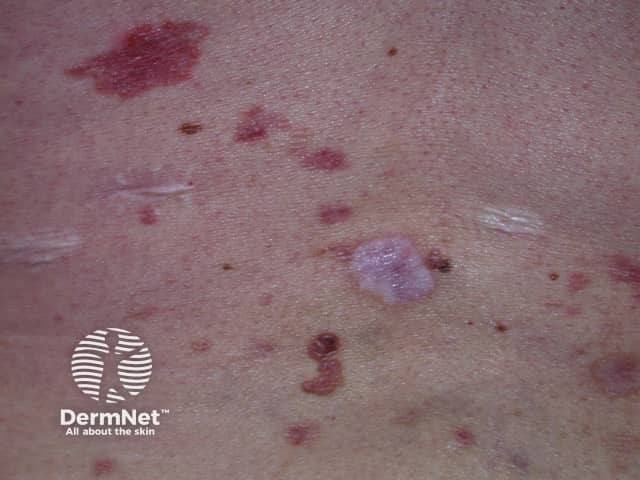 Basal cell carcinoma affecting the trunk