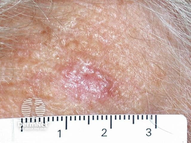 Basal cell carcinoma affecting the trunk