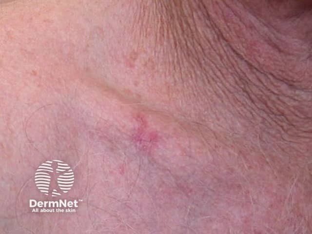 Basal cell carcinoma affecting the trunk