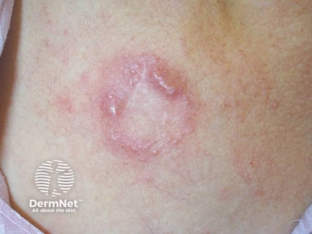 Basal cell carcinoma affecting the trunk