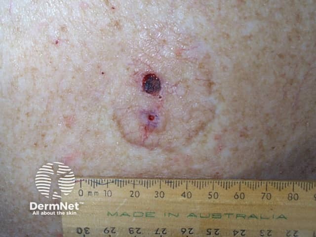 Basal cell carcinoma affecting the trunk