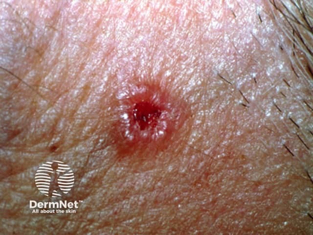 Nodular basal cell carcinoma