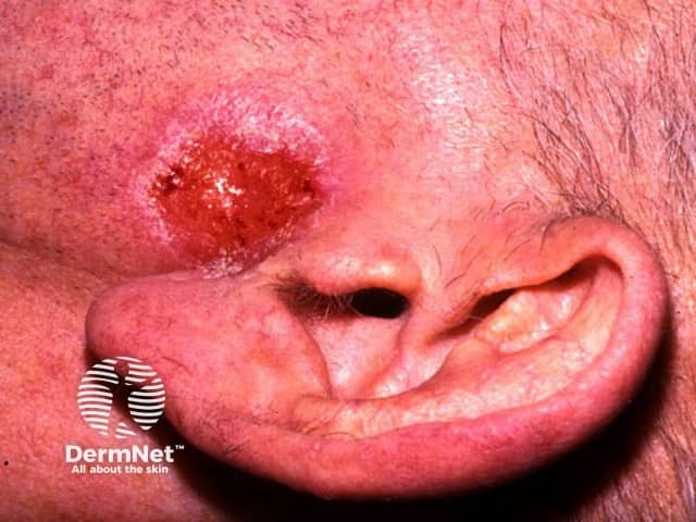 Basal cell carcinoma