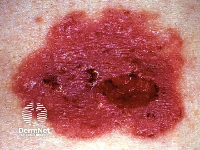 Basal cell carcinoma