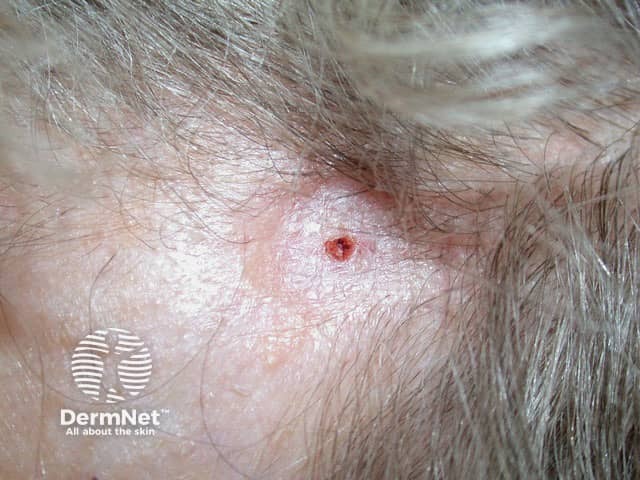 Morphoeic basal cell carcinoma