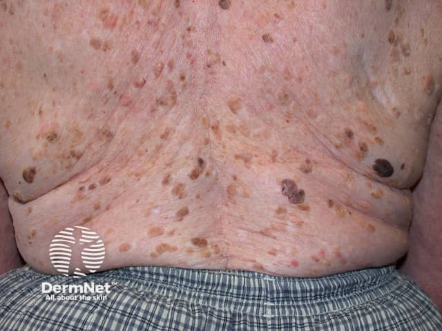 Seborrhoeic keratosis