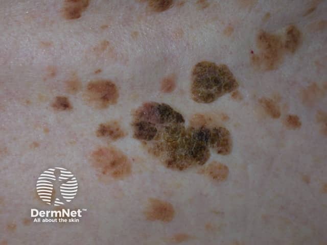 Seborrhoeic keratosis