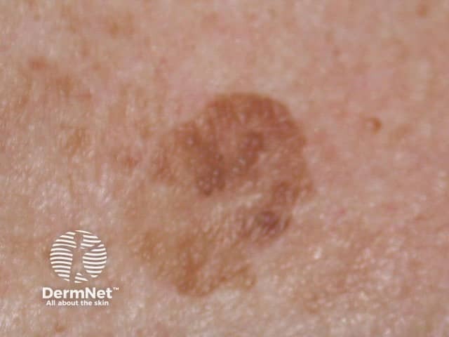 Seborrhoeic keratosis