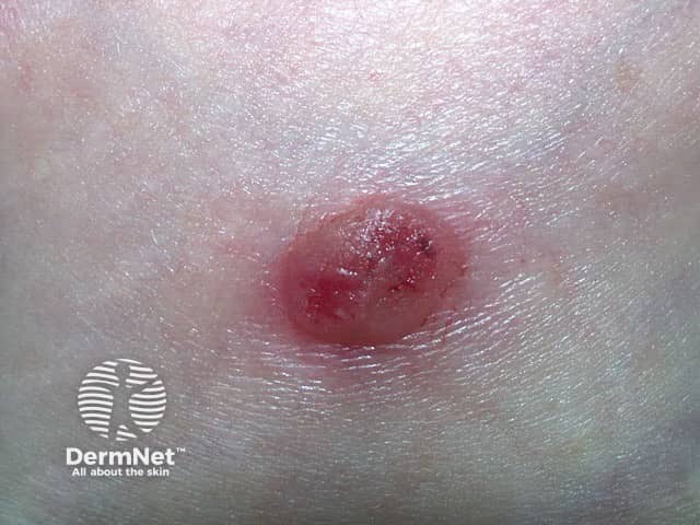 Irritated seborrhoeic keratosis