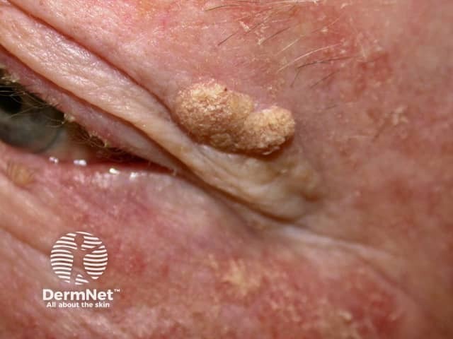 Seborrhoeic keratosis