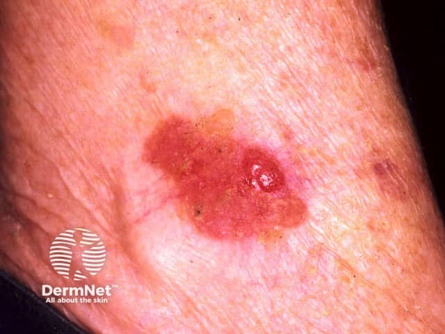 Squamous cell carcinoma