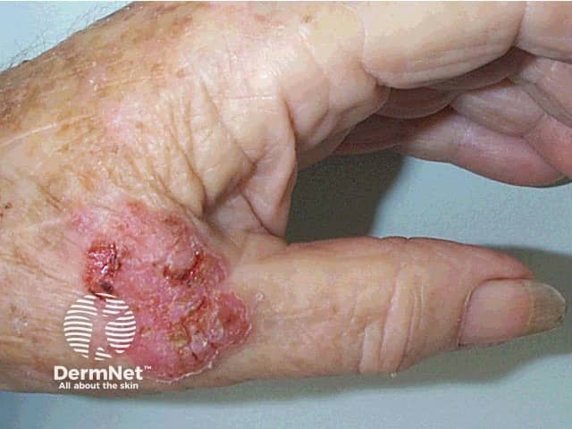 Squamous cell carcinoma