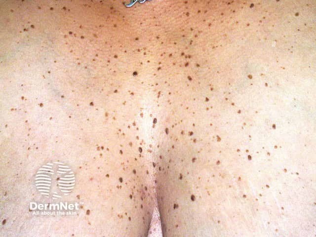 Dermatosis papulosa nigra