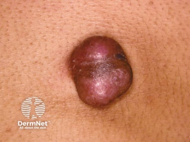 Dermatofibrosarcoma protuberans