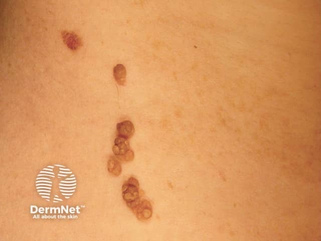 Epidermal naevus