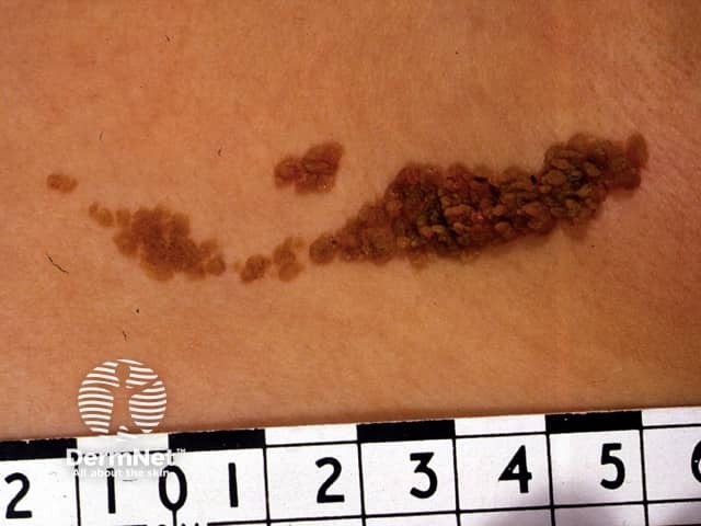 Epidermal naevus