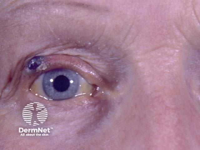 Eyelid melanoma