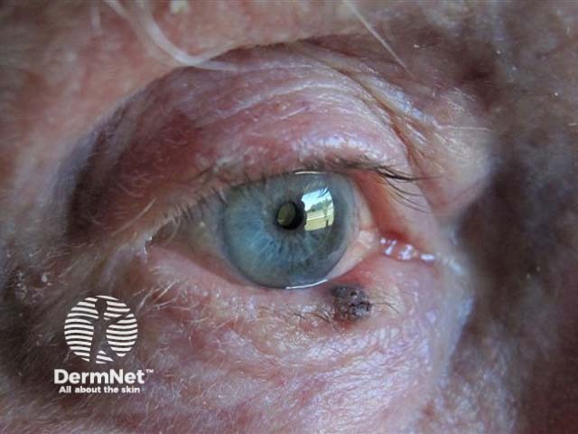 Eyelid melanoma