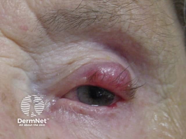 Merkel cell carcinoma