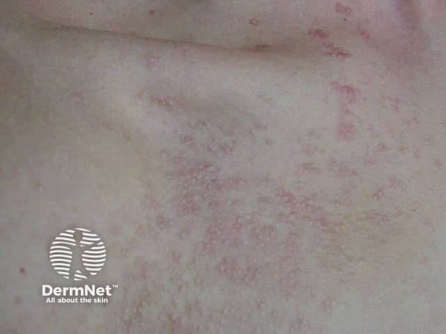 Fibrofolliculomas