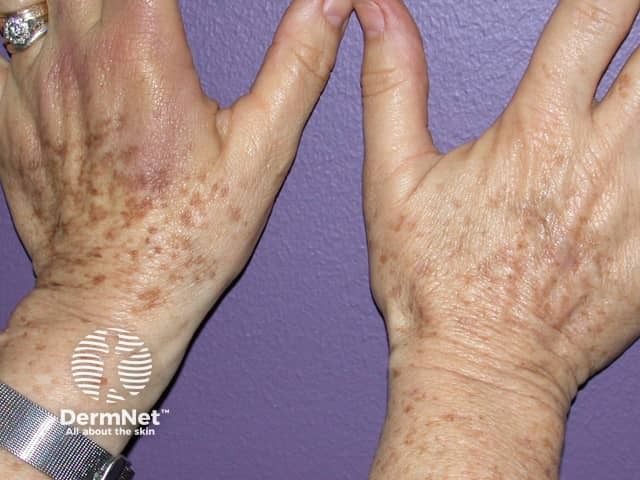 Freckles on hand before and after green laser light