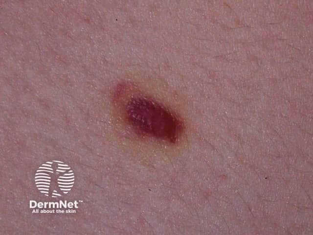 Kaposi sarcoma