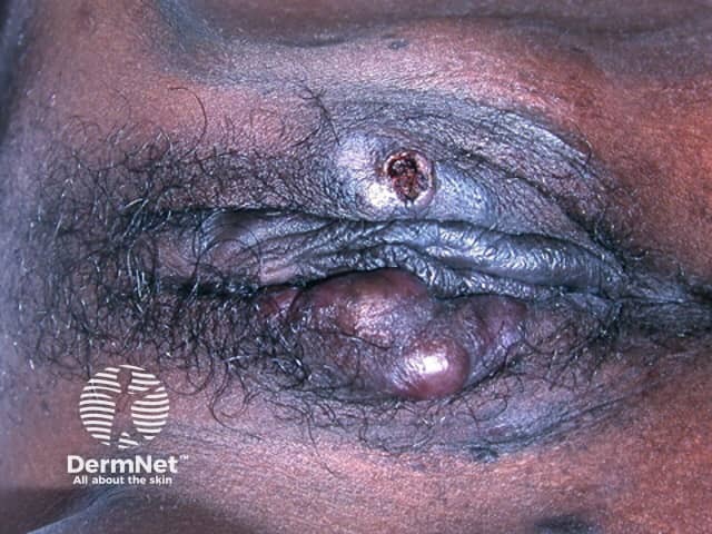 Kaposi sarcoma