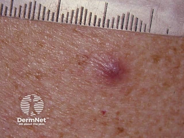 Kaposi sarcoma