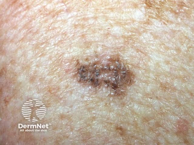 Lentiginous melanoma