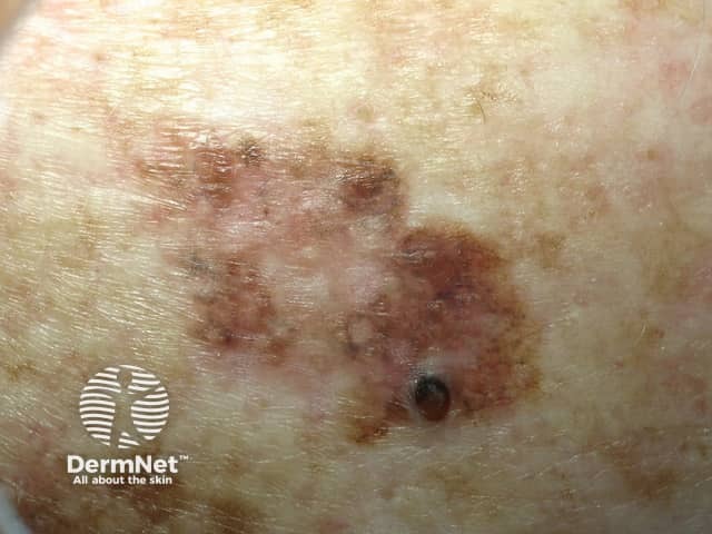 Lentiginous melanoma