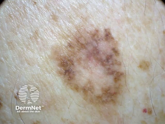 Lentiginous melanoma