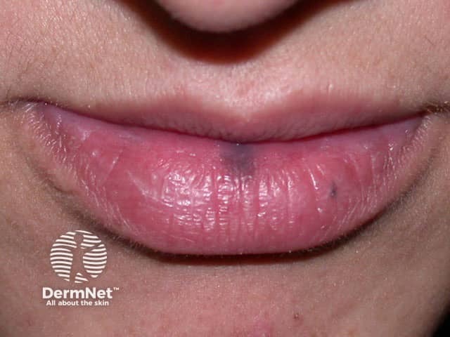 Labial melanotic macule