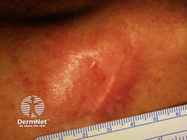 Desmoplastic melanoma