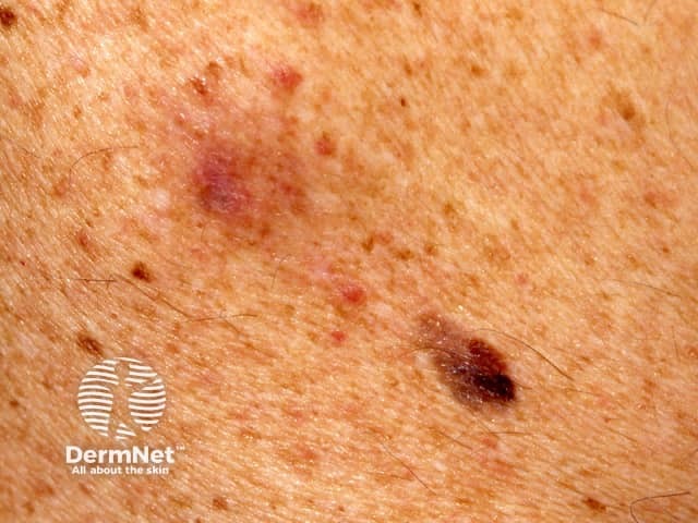 Desmoplastic melanoma