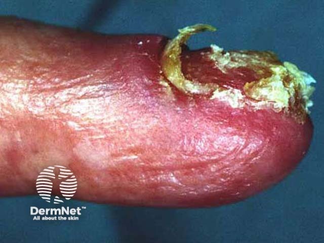 Amelanotic subungual melanoma