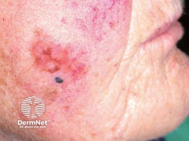 Nodule within LM melanoma