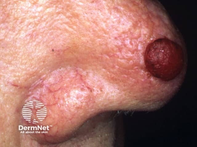 Amelanotic nodular melanoma