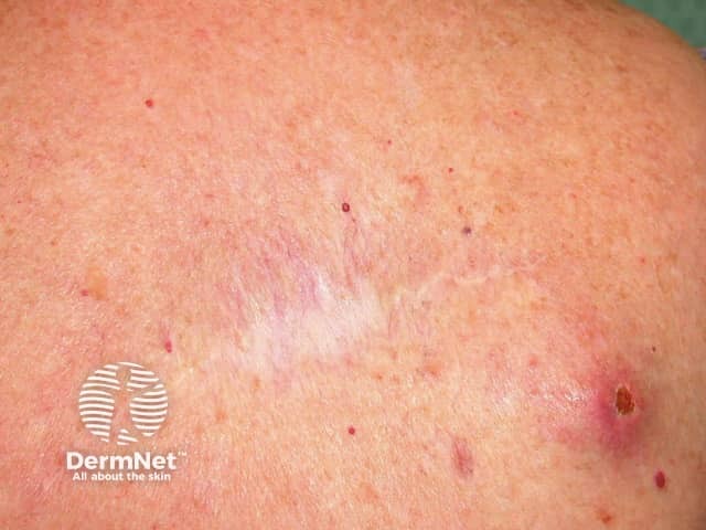 Metastatic melanoma near excision site