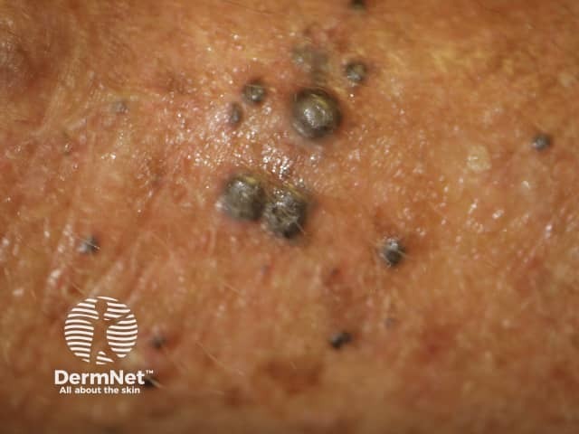 Metastatic melanoma