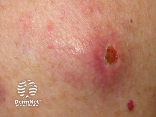 Metastatic melanoma