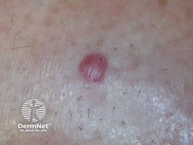 Metastatic melanoma