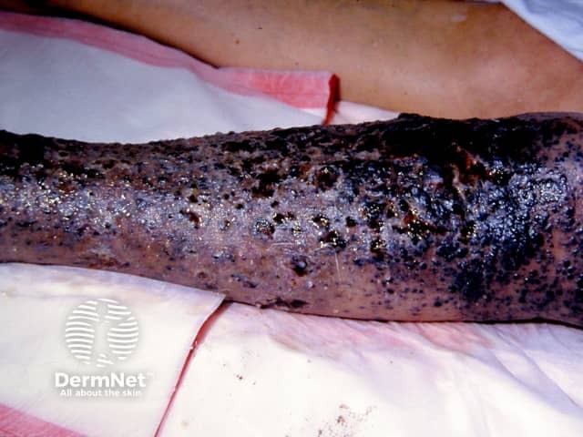 Metastatic melanoma