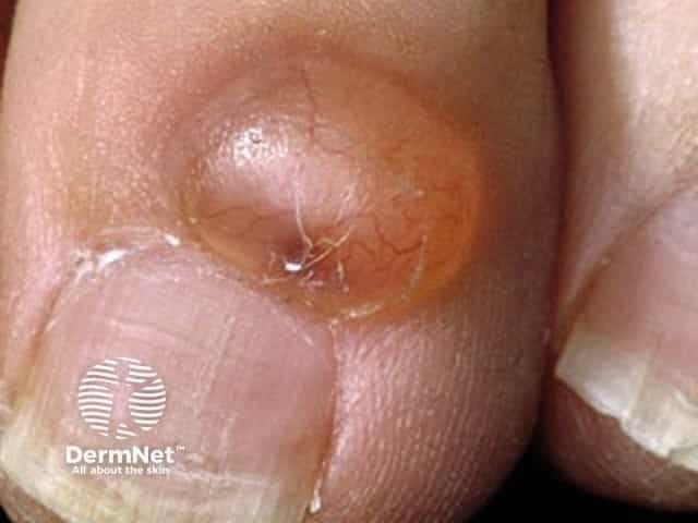 Myxoid cyst