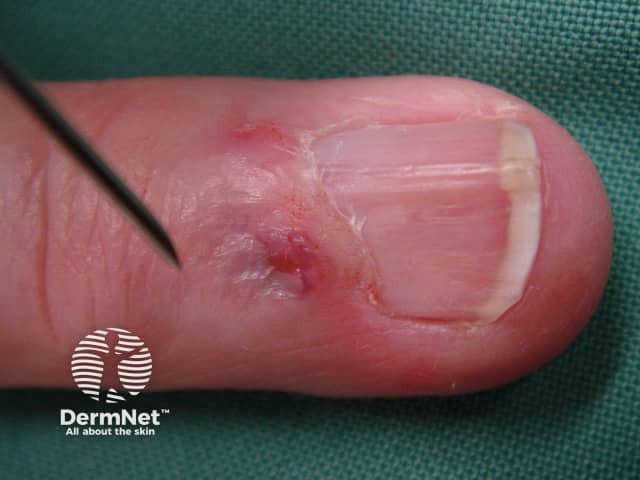 Needling a myxoid cyst