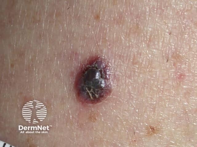 Melanoma