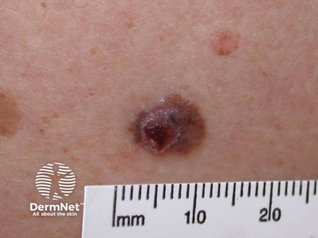 Basal cell carcinoma