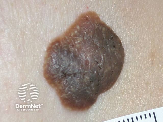 Pigmented seborrhoeic keratosis