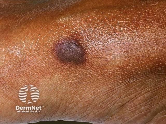 Kaposi sarcoma