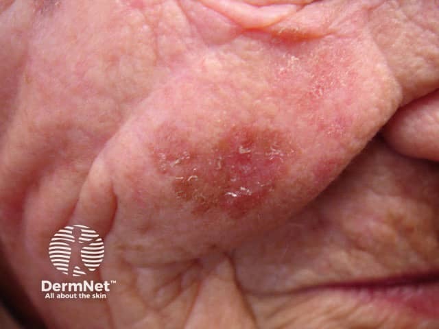 Actinic keratosis