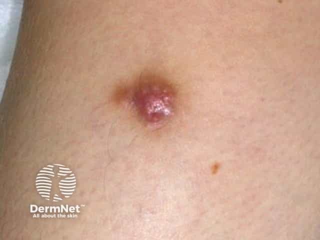 Dermatofibroma